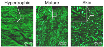 Image showing various scar tissues under SHG imaging and optical imaging